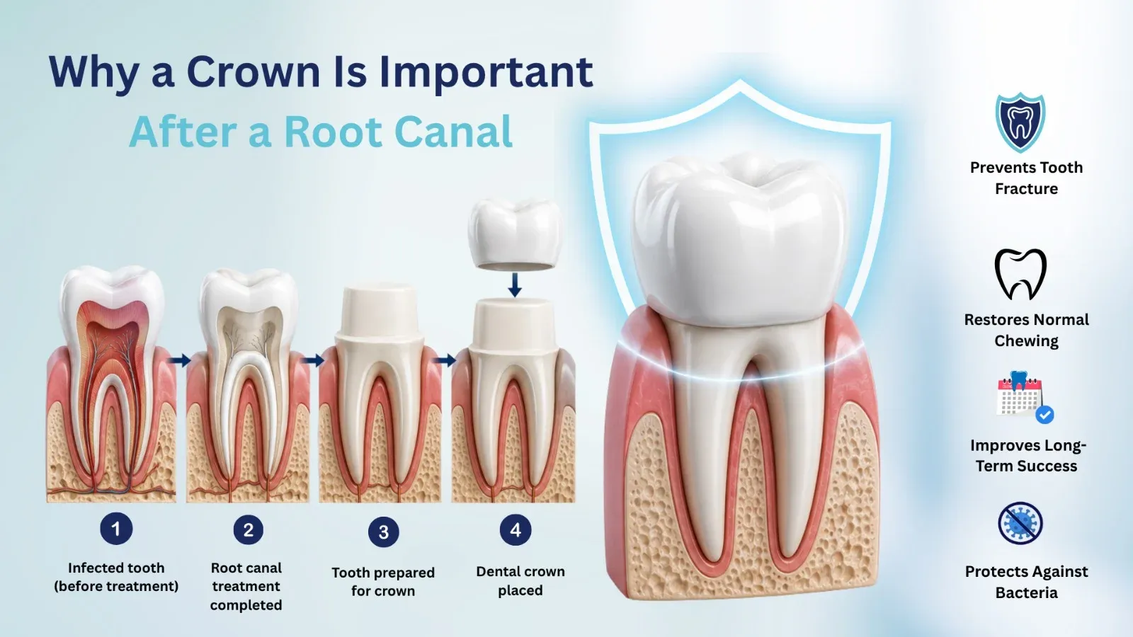 Illustration showing dental crown placement after root canal treatment to protect and restore a treated tooth.